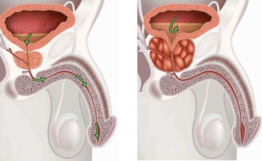 Informatie over de ziekte prostatitis