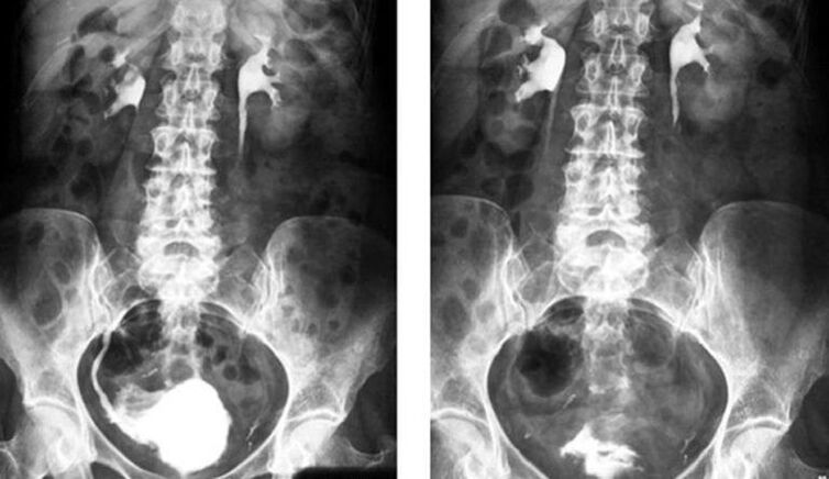 urografie voor het diagnosticeren van prostatitis